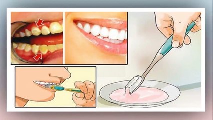 Débarrassez-vous de la plaque dentaire en seulement 5 minutes ! Cela va changer votre vie !