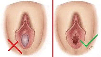 Causes Of Broken Hymen Beside Sex | Ways to fix it .