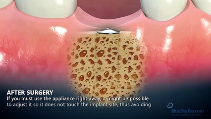 How do dental implants work video