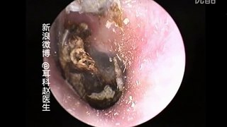 Earwax Removal, Extractions by hook Right Next to Eardrum 鼓膜大饼 外耳道挖耳屎清理 耳垢 耳垢