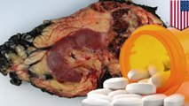 High intake of vitamin B linked to lung cancer in men