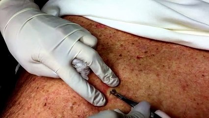 Précédent dos point noir kyste éducation pour médical sur le le le le la mise à jour x2 extrion nsfe