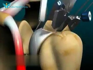 Total Shoulder Replacement Surgery - إجمالي جراحة استبدال الكتف
