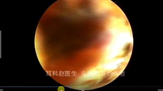 12 part Earwax Removal, Extractions 12段耵聍清理的大合辑，外耳道挖耳屎清理 耳垢 耳垢