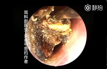 Earwax Removal, Extractions Selected Video 精选合集1 外耳道挖耳屎清理 耳垢 耳垢