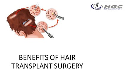 BENEFITS OF HAIR TRANSPLANT SURGERY
