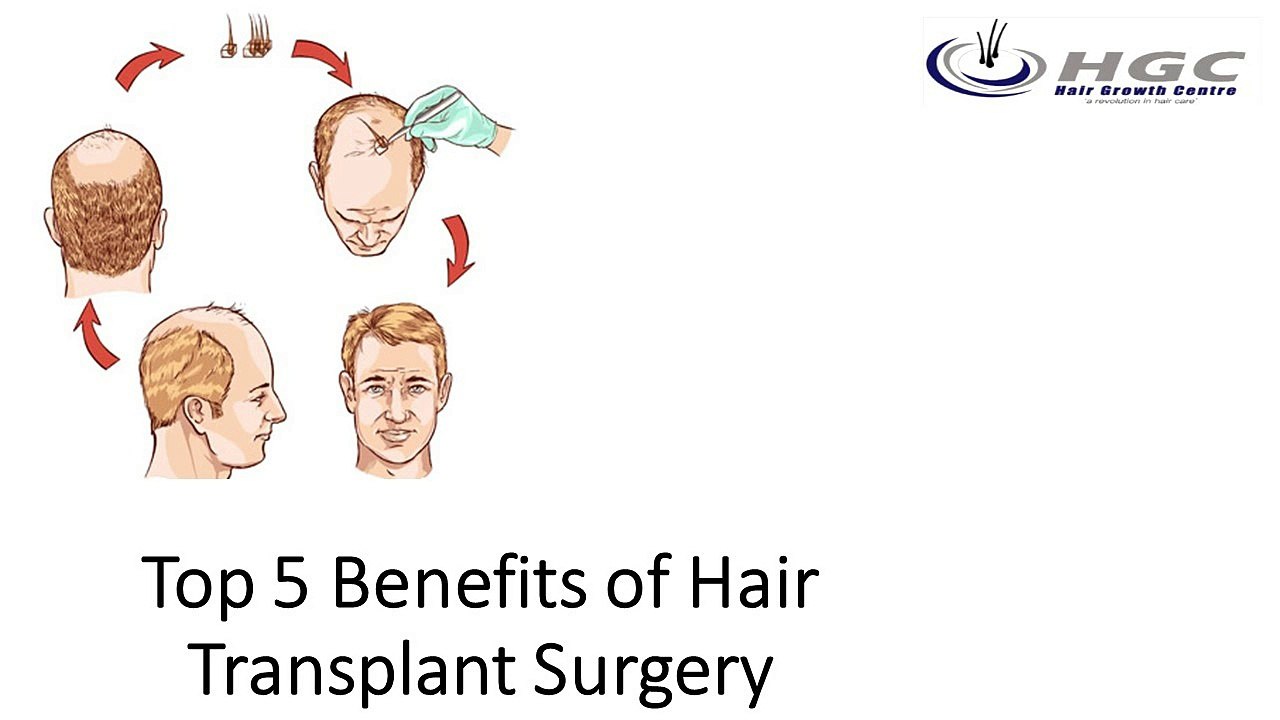 Top 5 Benefits of Hair Transplant Surgery
