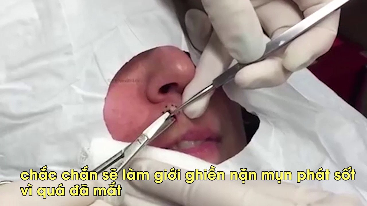 Pha nặn mụn “khủng”, to như hạt bắp khiến các tín đồ nặn mụn lại phát sốt