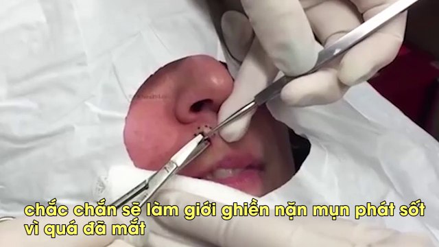 Pha nặn mụn “khủng”, to như hạt bắp khiến các tín đồ nặn mụn lại phát sốt