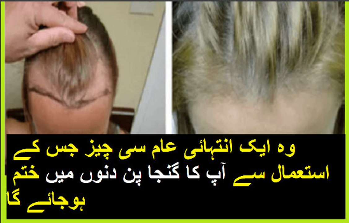 وہ ایک انتہائی عام سی چیز جس کے استعمال سے آپ کا گنجا پن دنوں میں ختم ہوجائے گا