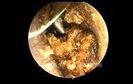 12 part Earwax Removal, Extractions 12段耵聍清理的大合辑，外耳道挖耳屎清理 耳垢 耳垢
