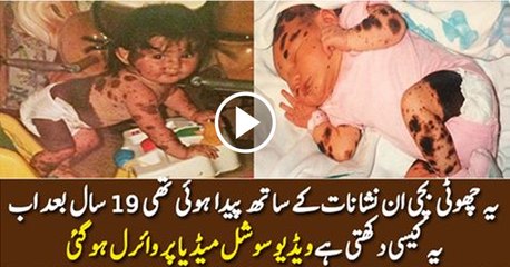 This Girl Was Born With Birthmarks But Now Look At Her After 19 Years