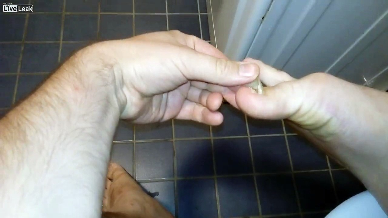 Il s'enlève l'ongle du gros orteil déjà bien pourri après l'avoir cassé !