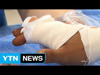 손가락 절단 부위 적절한 보관이 관건 / YTN