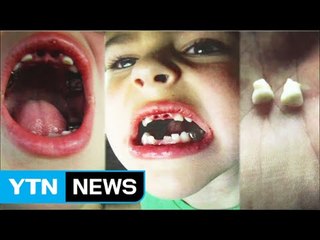 美 치과의사, 저소득층 어린이들 생니 뽑아 거액 건강보험료 챙겨 / YTN