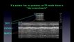 Ultrasound video 13-Critical-Care-Ultrasound-Vignettes-3