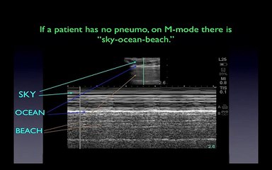 Ultrasound video 13-Critical-Care-Ultrasound-Vignettes-3