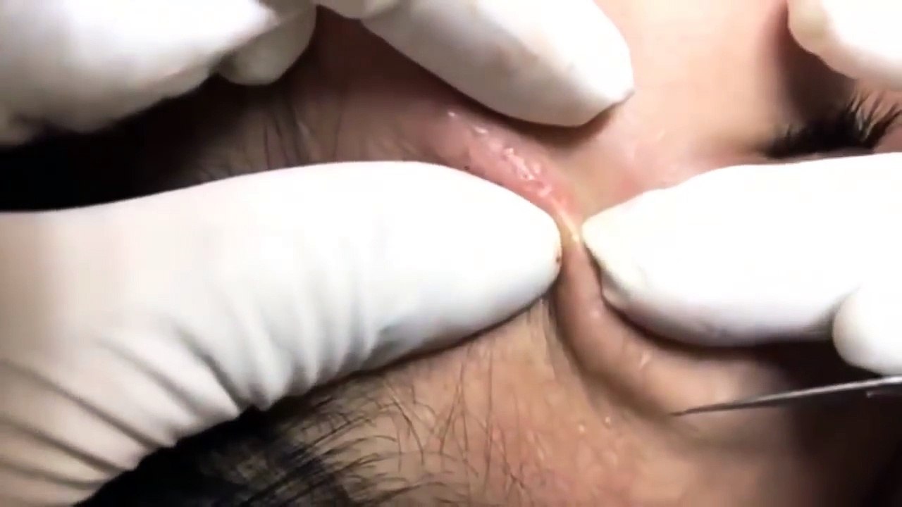 Remove the most blackheads in 2017