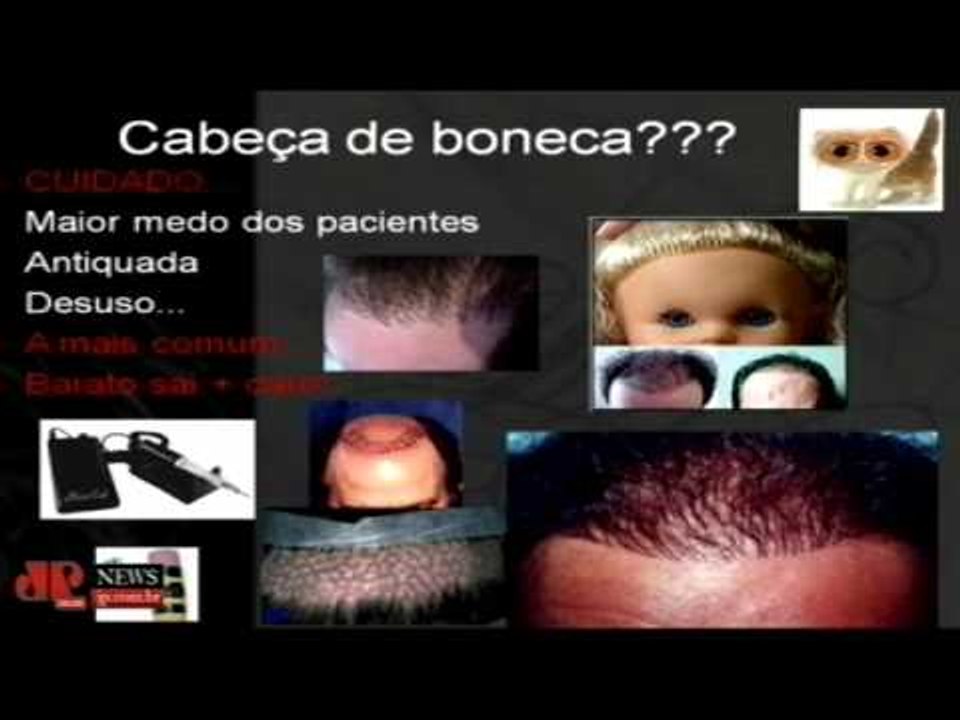 Médico fala dos tratamentos da calvície e do implante capilar