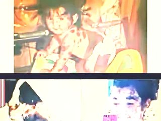 This Girl Was Born With Birthmarks But Now Look At Her 19 Years Later