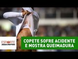 Olha isso! Copete sofre acidente e mostra queimadura na barriga