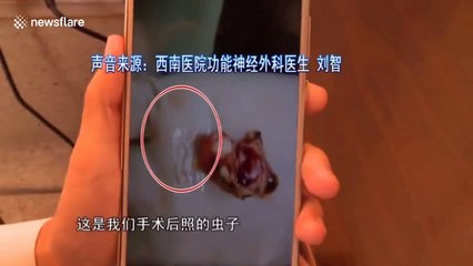 Doctor removes live parasite from teenager's head