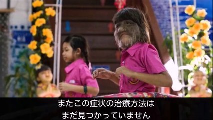 世界で最も奇妙な病気7選