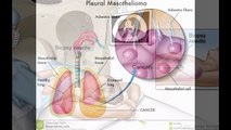 Mesothelioma survival rates