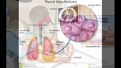 Mesothelioma survival rates