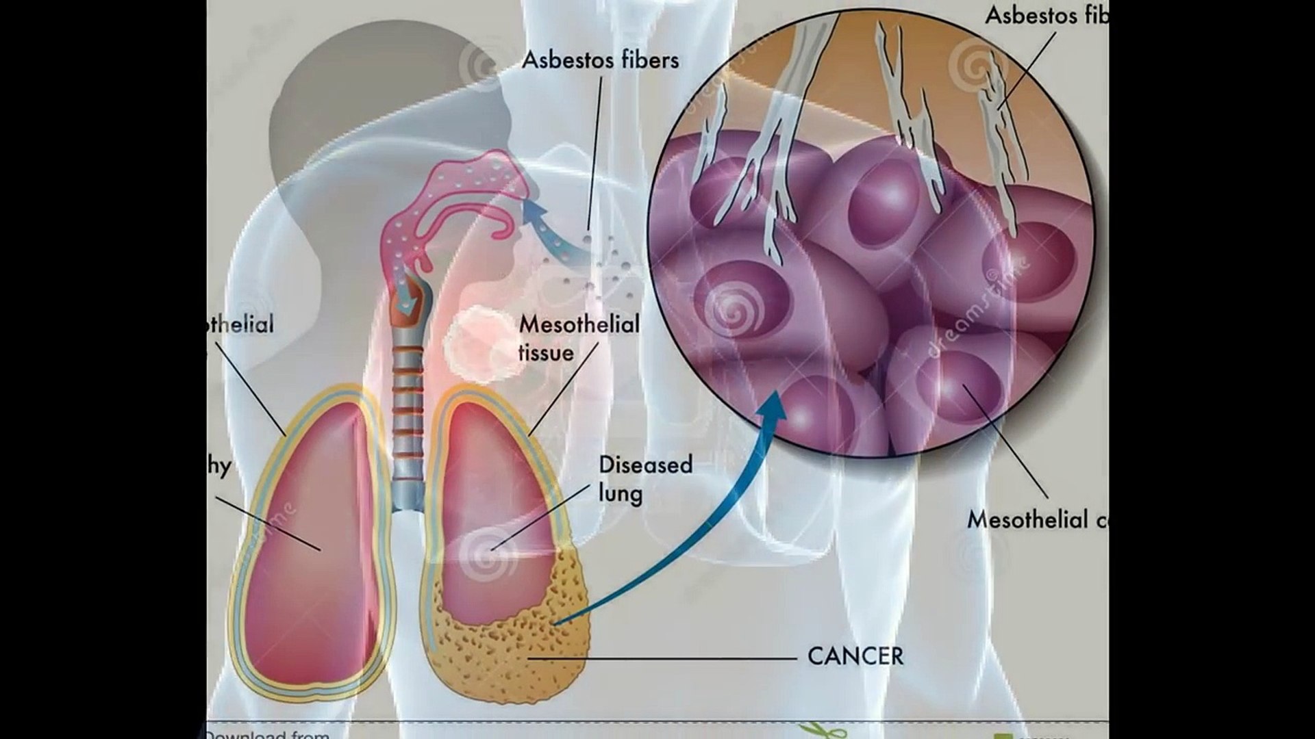 what is the life expectancy of stage 4 breast cancer