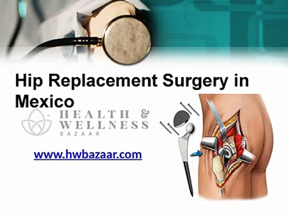 Hip Replacement Surgery in Mexico at Very Affordable Rates