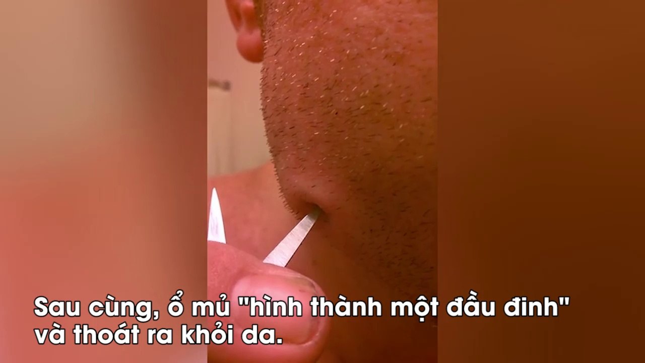 Cảnh nặn mụn bọc bị áp xe bằng kéo khiến người xem toát cả mồ hôi hột