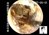 Earwax Removal, Extractions Endoscopy Clean Chip Like Earwax Bothside 耳内镜清理干片两例 外耳道挖耳屎清理 耳