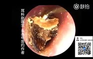 Earwax Removal, Extractions Selected Video 精选合集1 外耳道挖耳屎清理 耳垢 耳垢