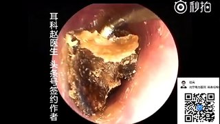 Earwax Removal, Extractions Selected Video 精选合集1 外耳道挖耳屎清理 耳垢 耳垢