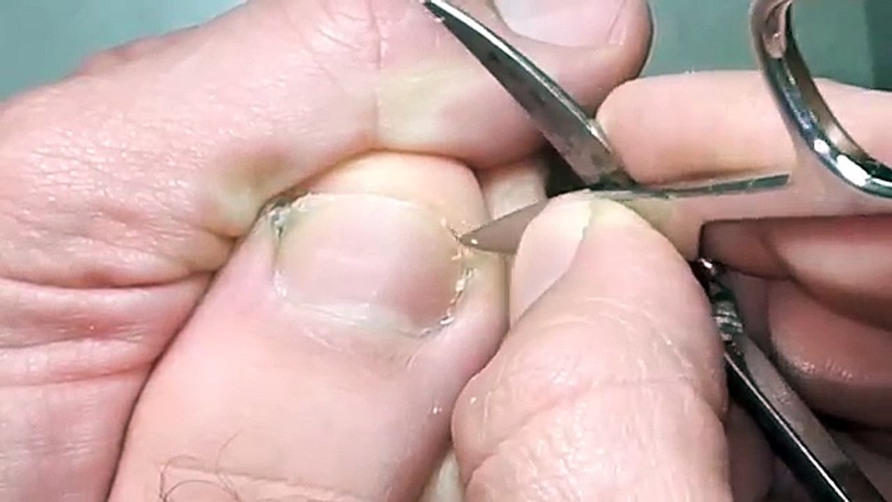 How to remove ingrown toenail. Nail espicule removal.