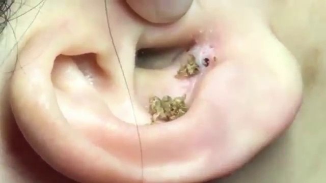 Pha nặn mụn lâu năm