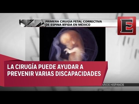 Cirujanos de la UNAM realizan con éxito cirugía fetal correctiva