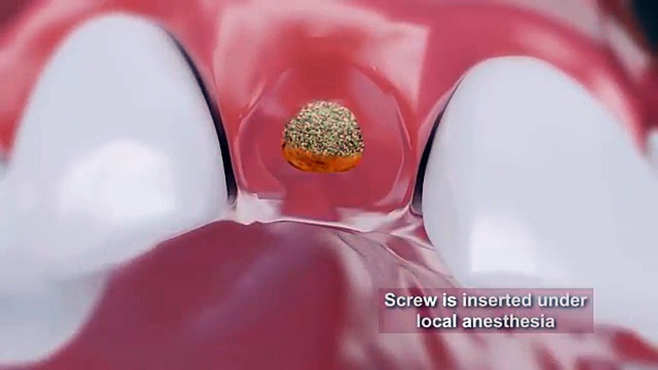 Dental Implants treatment animation video