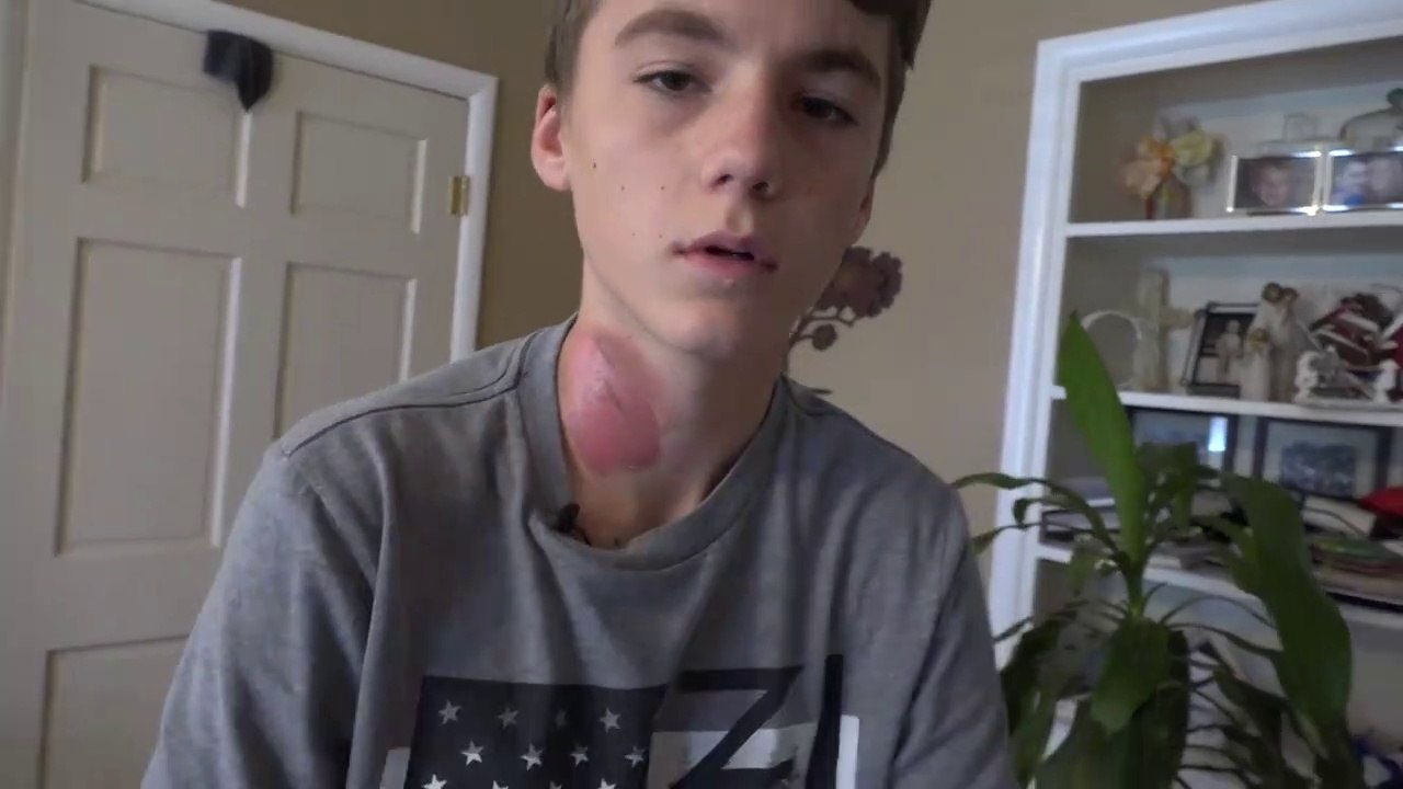 Ses amis lui versent de l'eau bouillante sur le visage alors qu'il dort.