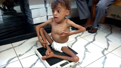 UN: Yemen faces world's 'largest humanitarian crisis'
