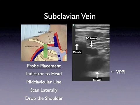 ultrasound video 17-SE-CLiP Sonographic-Evaluation-of-C