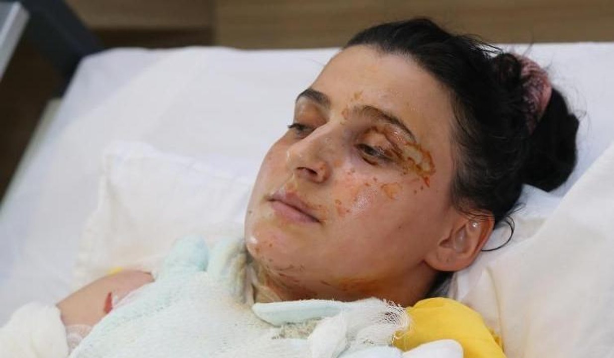 Anne ile kızı jel yakıtla yandı