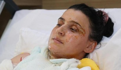 Anne ile kızı jel yakıtla yandı