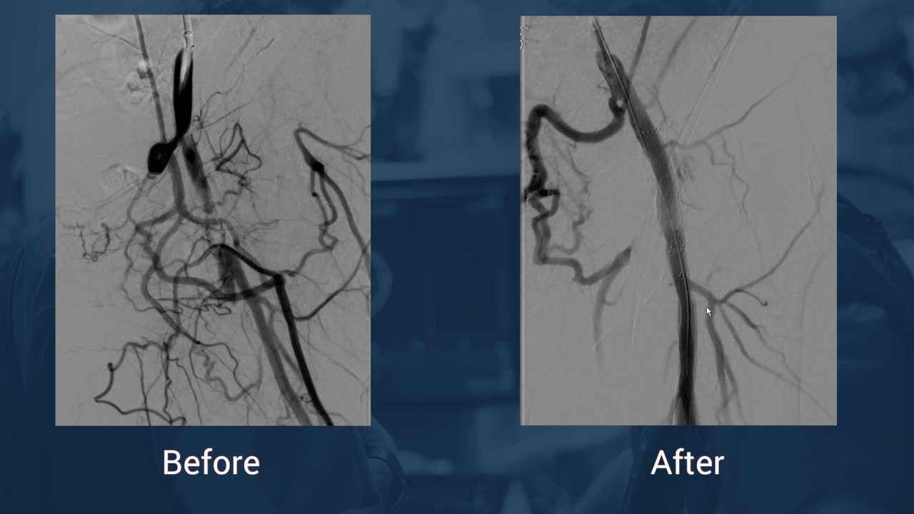 Long femoro-popliteal thrombosis