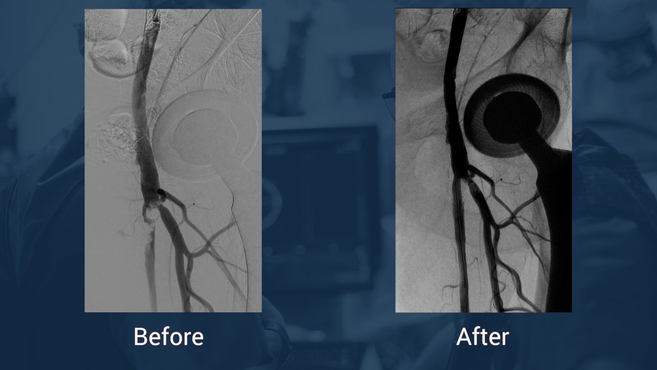 Short calcified proximal SFA lesion