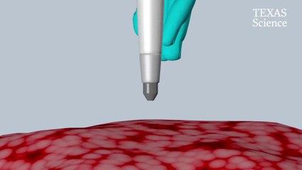 Este bolígrafo detecta el cáncer en solo 10 segundos