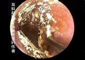 Earwax Removal, Extractions FUNGI and MOLD in the ear! 耳道内真菌，霉菌的清除 外耳道挖耳屎清理 耳垢 耳垢