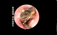 Earwax Removal, Extractions From A young Lady 一位女青年的右耳，外耳道挖耳屎清理 耳垢 耳垢