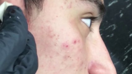 Il se fait vider un kyste par son coiffeur... Coup de rasoir!